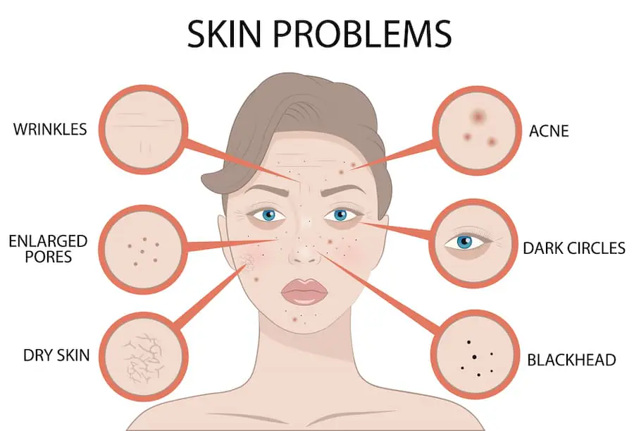 a woman with acne marks on her face